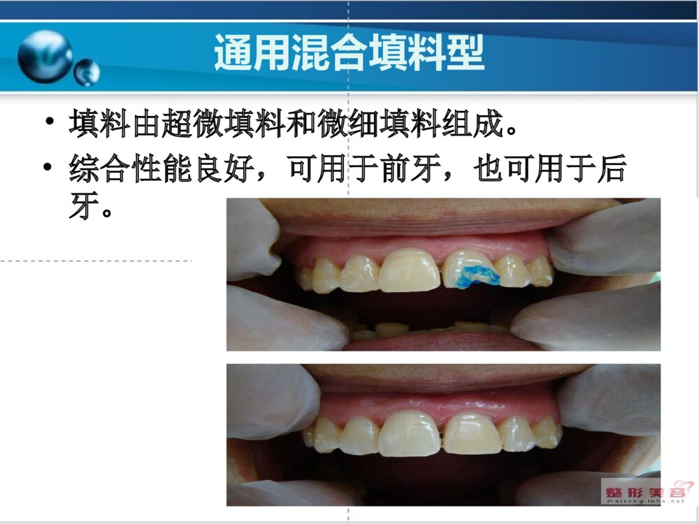 牙体缺损充填PPT课件10